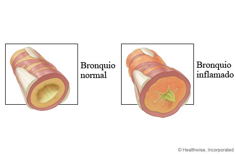 bronquiolite1